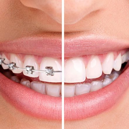 Braces